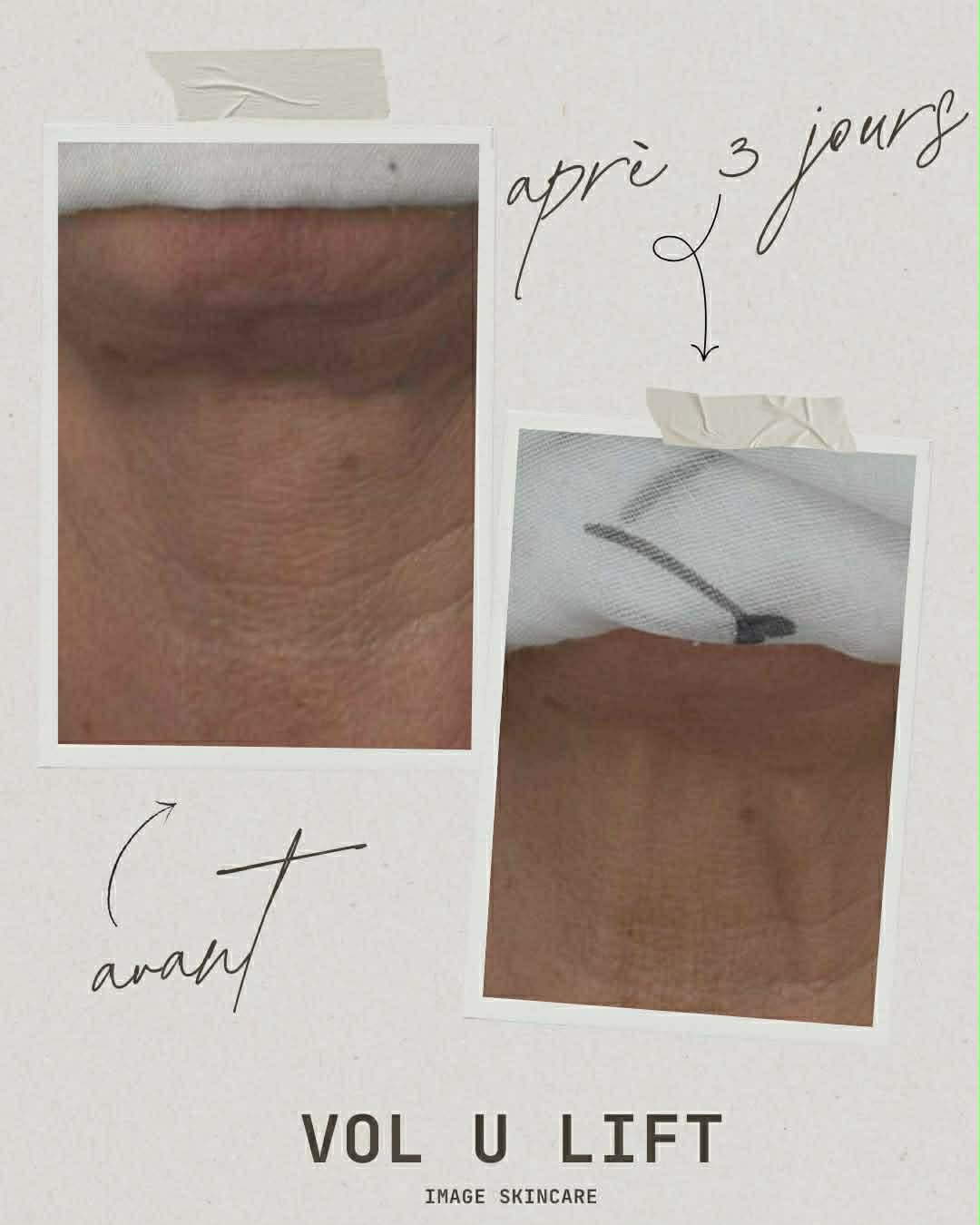 VOL.U.LIFT™ GLP-1 4D Skin Rebound Complex