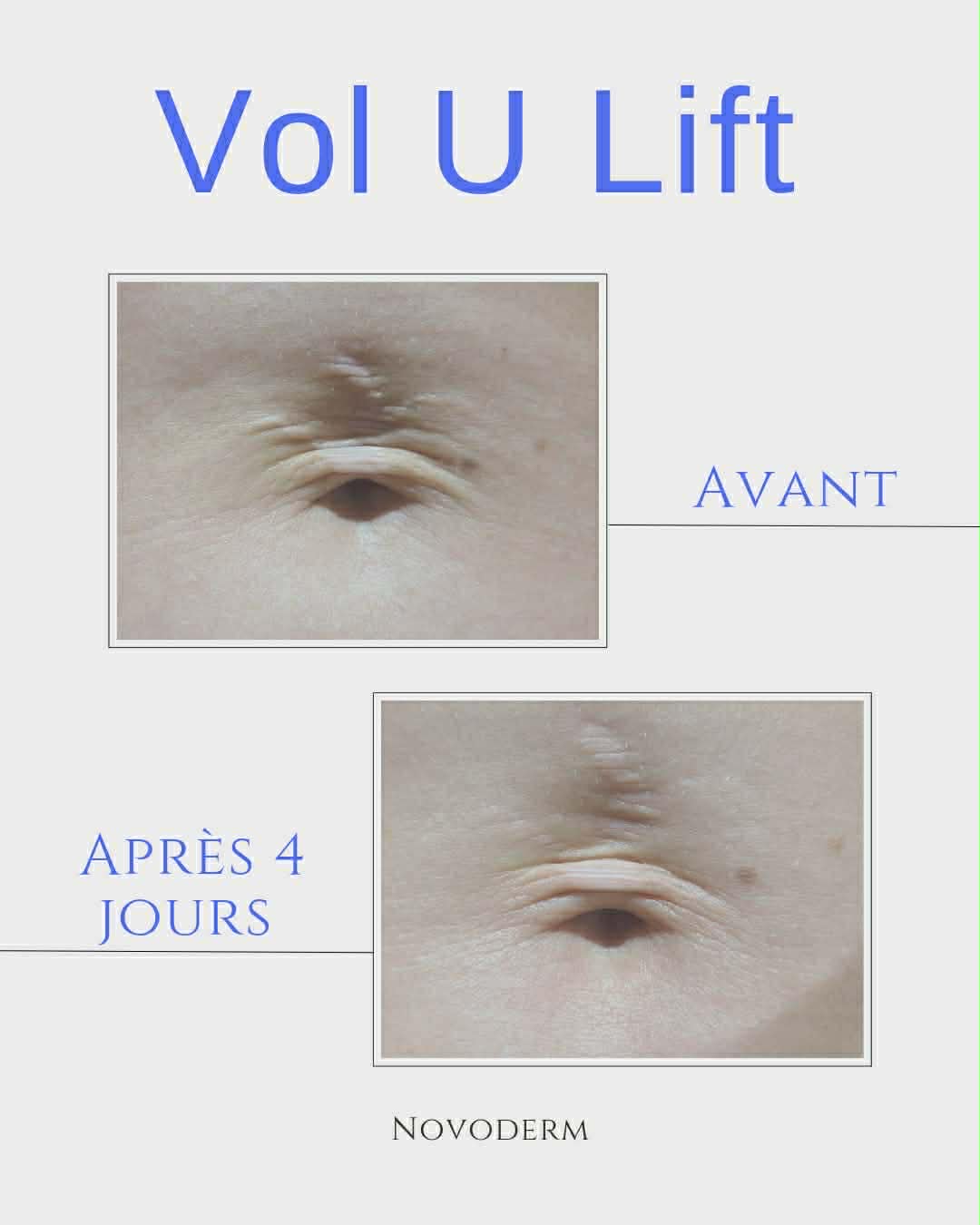 VOL.U.LIFT™ GLP-1 4D Skin Rebound Complex