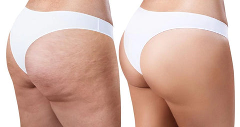 Traitement cellulite celluliflex